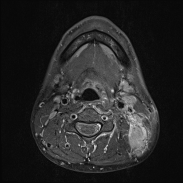 Nasopharyngeal carcinoma with skull base invasion (Radiopaedia 53415-59485 Axial T1 C+ fat sat 50).jpg
