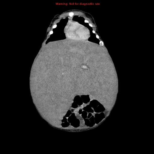 File:Neonatal neuroblastoma (Radiopaedia 9564-10223 B 40).jpg