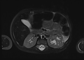 Neonatal prostatic utricle abscess - cyst (Radiopaedia 69511-79394 Axial T2 fat sat 55).jpg