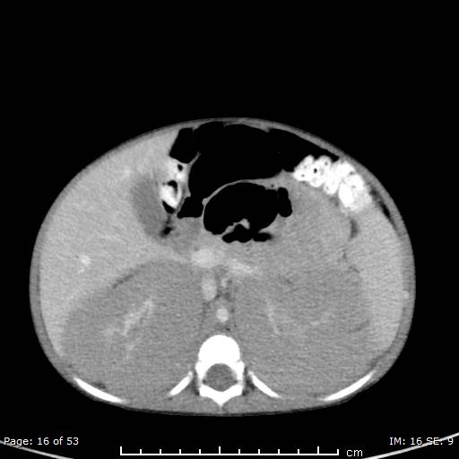 File:Nephroblastomatosis (Radiopaedia 41934-44935 A 16).jpg