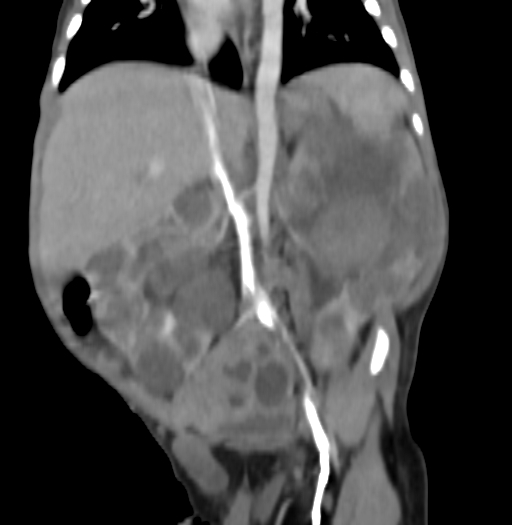 Nephroblastomatosis (Radiopaedia 71294-81607 B 202).jpg