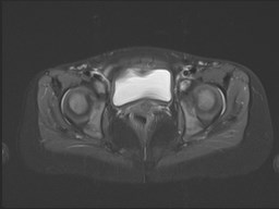 File:Neuroblastoma with bone metastases (Radiopaedia 67080-76414 Axial STIR 49).jpg