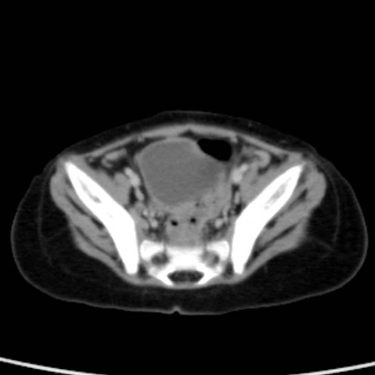 Neuroblastoma with skull metastases (Radiopaedia 30326-30960 C 51).jpg