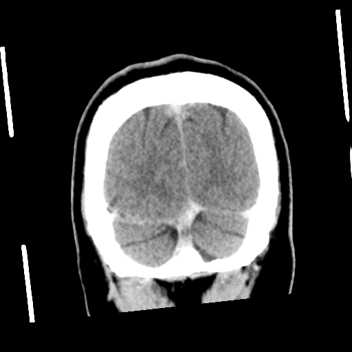 Neurocysticercosis - granular nodular (Radiopaedia 42786-45957 Coronal C+ 57).png