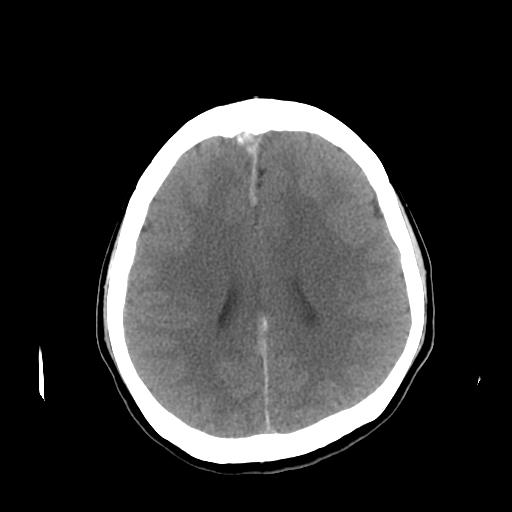 File:Neurofibromatosis type 2 (Radiopaedia 25389-25637 Axial non-contrast 17).jpg