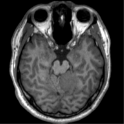 File:Neurofibromatosis type 2 (Radiopaedia 44936-48838 Axial T1 48).png