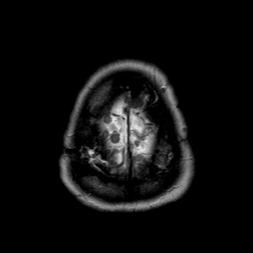 File:Neurofibromatosis type 2 (Radiopaedia 8713-9518 Axial T2 2).jpg