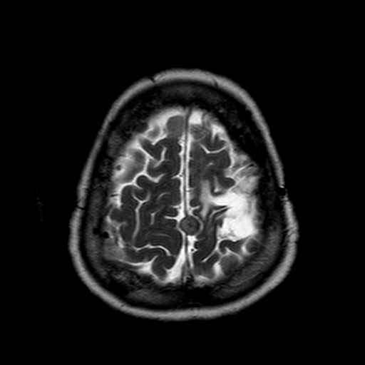 File:Neurofibromatosis type 2 (Radiopaedia 8713-9518 Axial T2 4).jpg