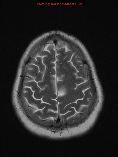 File:Neuroglial cyst (Radiopaedia 10713-11184 Axial T2 4).jpg