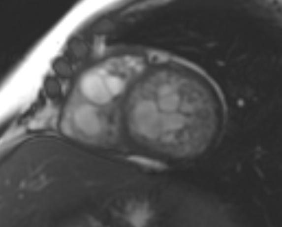 File:Non-compaction of the left ventricle (Radiopaedia 69436-79314 Short axis cine 120).jpg
