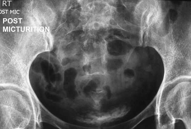 File:Non-functioning kidney on intravenous urography (Radiopaedia 22970-23000 F 1).jpg