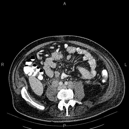 File:Non Hodgkin lymphoma in a patient with ankylosing spondylitis (Radiopaedia 84323-99621 B 46).jpg