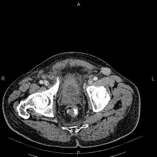 File:Non Hodgkin lymphoma in a patient with ankylosing spondylitis (Radiopaedia 84323-99621 B 61).jpg
