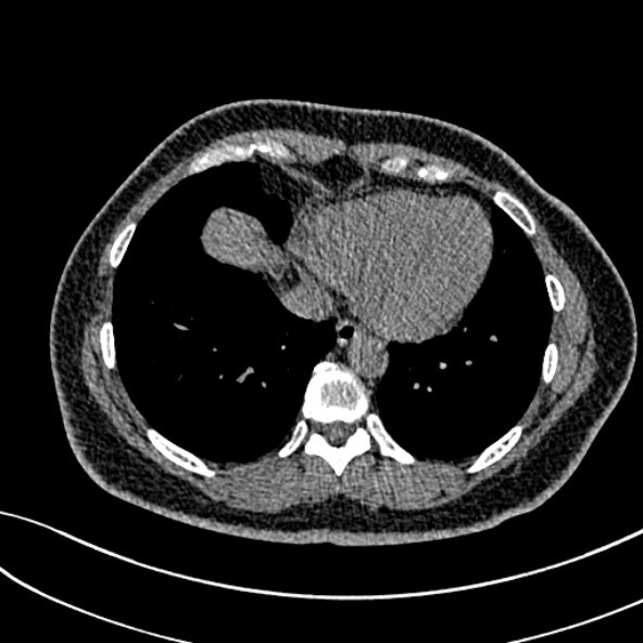 Normal CT chest- adult female (Radiopaedia 52522-58428 Axial non-contrast 94).jpg