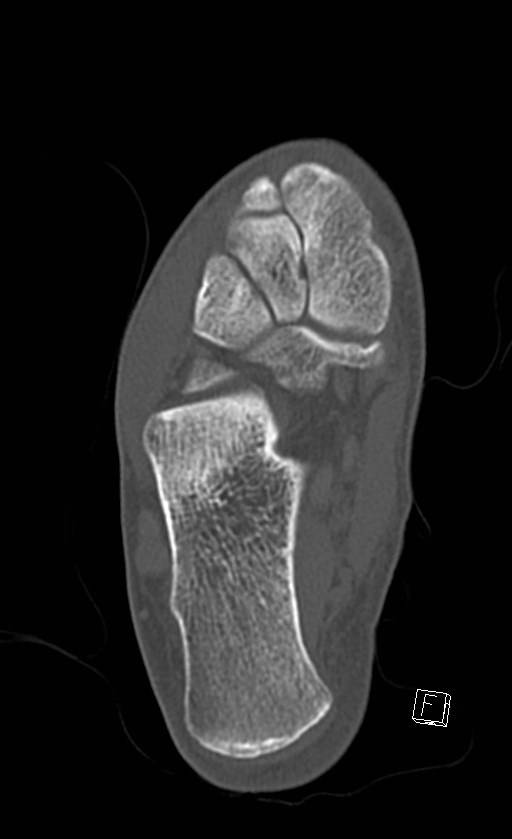 Normal CT of the ankle (Radiopaedia 47111-51658 Axial bone window 68).jpg