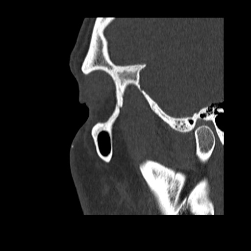 Normal CT paranasal sinuses (Radiopaedia 42286-45390 Sagittal bone window 94).jpg