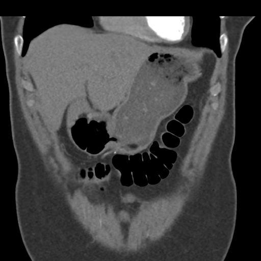 File:Normal CT renal artery angiogram (Radiopaedia 38727-40889 B 18).png