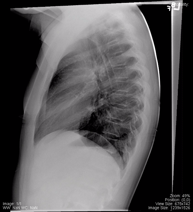 Normal Lateral Pediatric Chest x-ray.png