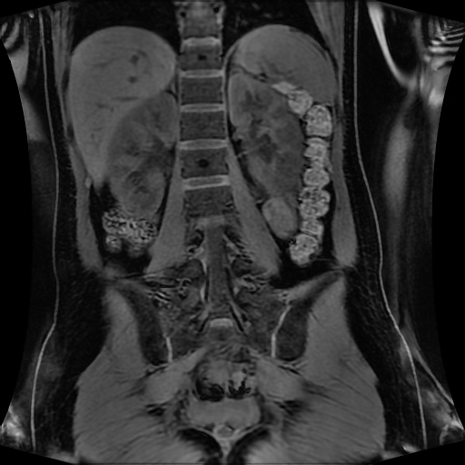 Normal MRI abdomen in pregnancy (Radiopaedia 88001-104541 M 95).jpg