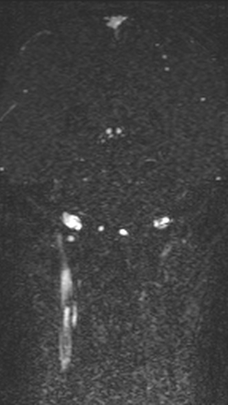 Normal MRI brain with MRV- teenager (Radiopaedia 49425-54553 Coronal MRV 156).jpg