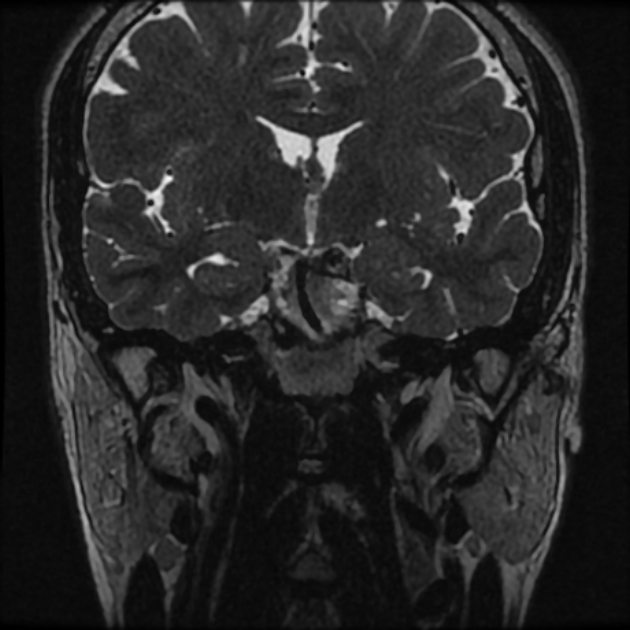 Normal MRI petrous (Radiopaedia 91317-108949 Coronal T2 20).jpg