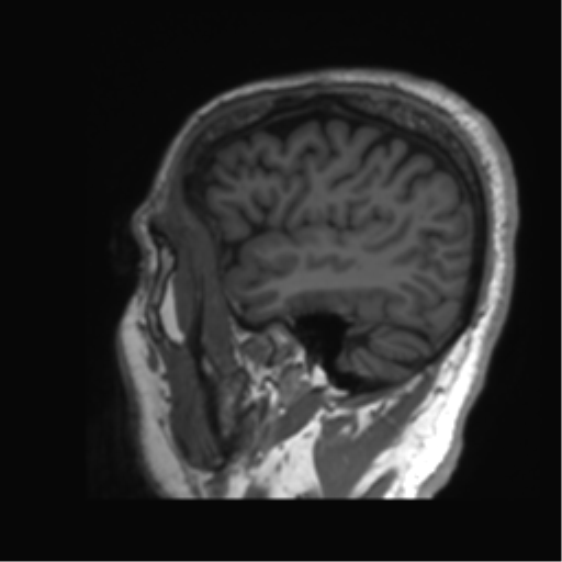 Normal brain MRI (non-focal epilepsy protocol) (Radiopaedia 53917-60040 Sagittal T1 58).png