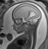 Normal brain fetal MRI - 22 weeks (Radiopaedia 50623-56050 Sagittal T2 Haste 9).jpg