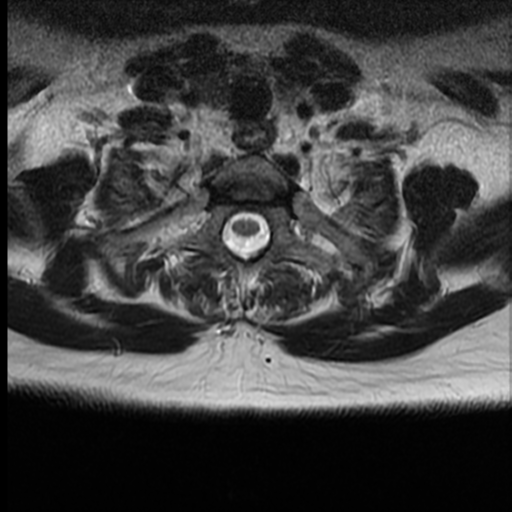 File:Normal cervical and thoracic spine MRI (Radiopaedia 35630-37156 H 40).png