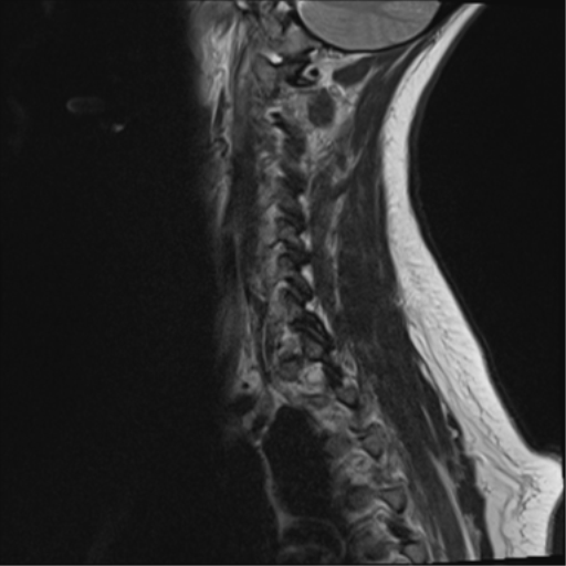 File:Normal cervical spine MRI (including Dixon) (Radiopaedia 42762-45925 Dixon- in-phase 14).png