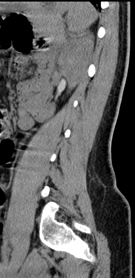 Normal lumbosacral CT (Radiopaedia 37923-39867 E 30).png