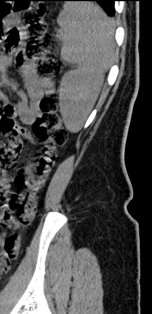 Normal lumbosacral CT (Radiopaedia 37923-39867 E 4).png