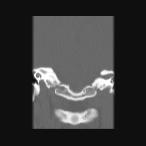 Normal sinus CT (annotated) (Radiopaedia 78917-91810 Coronal bone window 59).jpg
