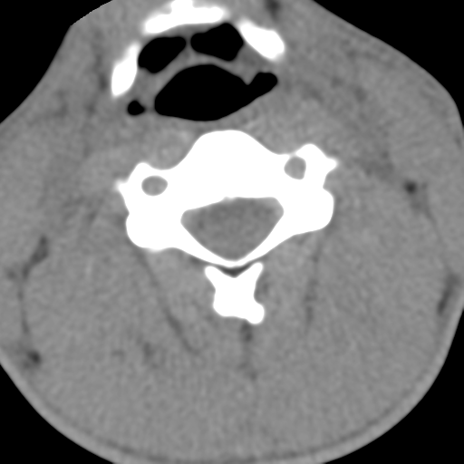 Normal trauma cervical spine (Radiopaedia 41017-43760 Axial non-contrast 30).png