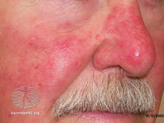 Rosacea (DermNet NZ acne-red-face-3640).jpg
