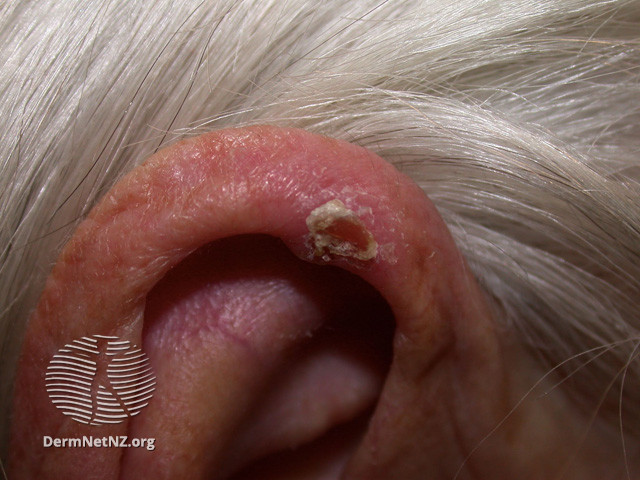 File:(DermNet NZ dermatitis-acd-face-2434).jpg