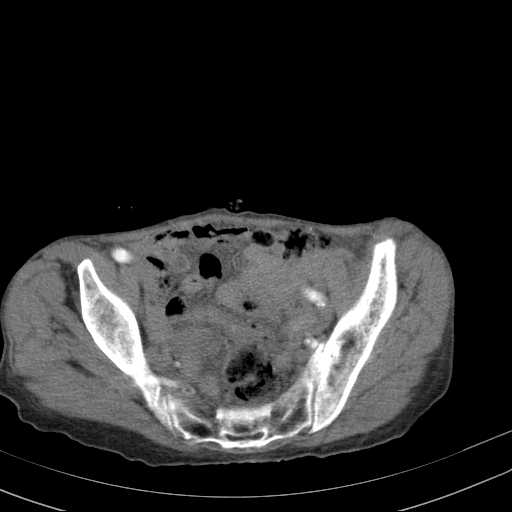 File:Abdominal aortic aneurysm (Radiopaedia 20827-20742 Axial C+ arterial phase 32).jpg