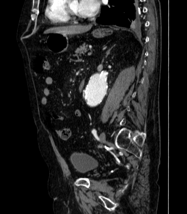 Abdominal aortic aneurysm (Radiopaedia 25855-26001 Sagittal C+ arterial phase 40).jpg