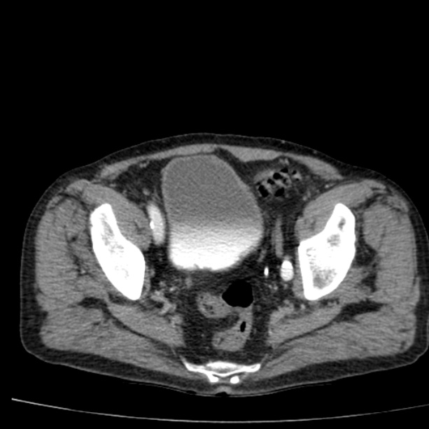 Abdominal aortic aneurysm (Radiopaedia 29248-29660 Axial C+ arterial phase 78).jpg