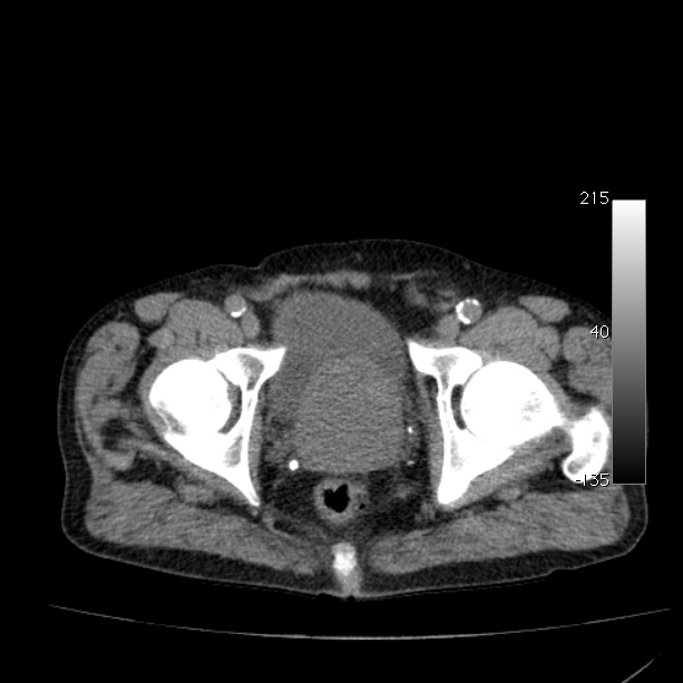 Abdominal aortic aneurysm (Radiopaedia 29248-29660 Axial non-contrast 55).jpg