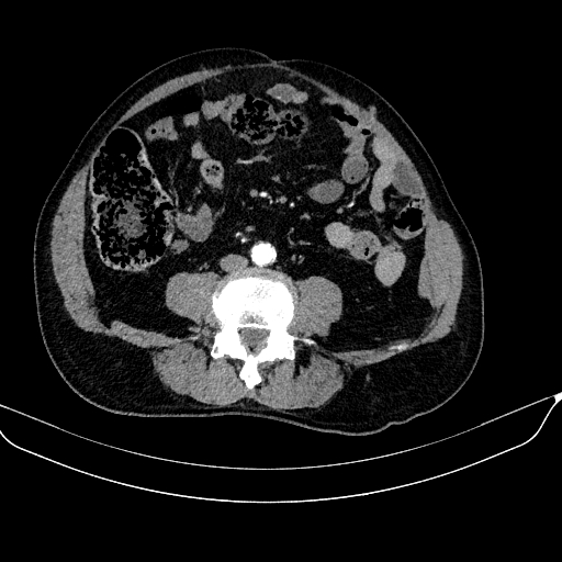 Abdominal aortic aneurysm (Radiopaedia 67117-76452 Axial C+ arterial phase 84).jpg