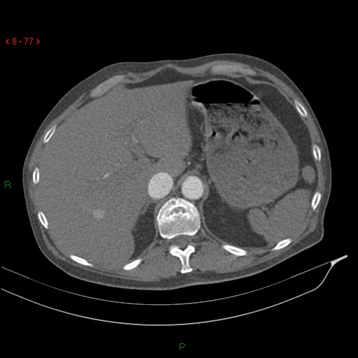 Abdominal aortic aneurysm rupture with aortocaval fistula (Radiopaedia 14897-14841 Axial C+ arterial phase 77).jpg