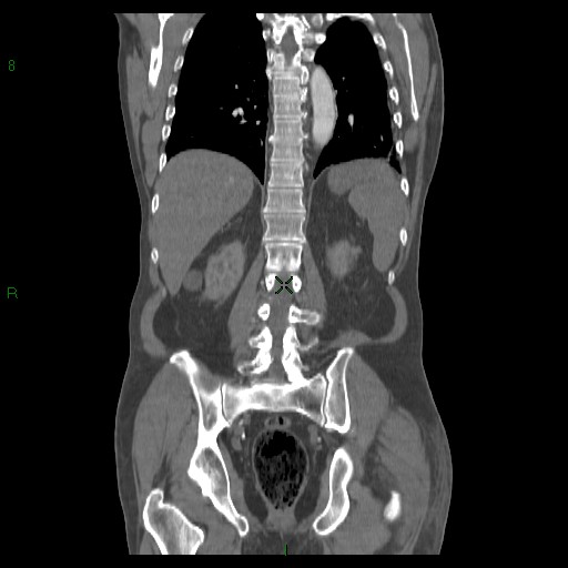 File:Abdominal aortic aneurysm rupture with aortocaval fistula (Radiopaedia 14897-14841 Coronal C+ arterial phase 32).jpg