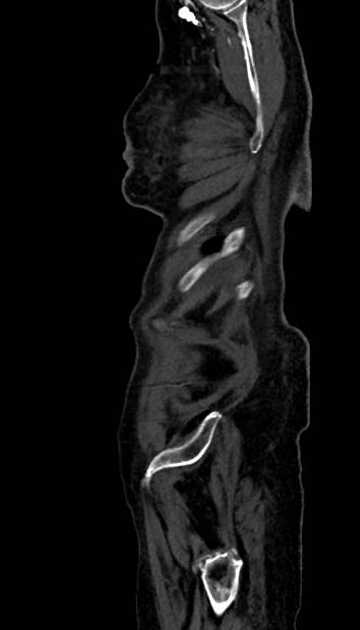Abdominal aortic aneurysm with thrombus fissuration (Radiopaedia 73192-83919 Sagittal C+ arterial phase 2).jpg