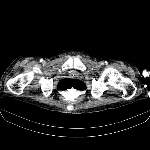 File:Abdominal collection due to previous cecal perforation (Radiopaedia 80831-94320 Axial C+ portal venous phase 208).jpg