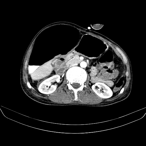 File:Abdominal collection due to previous cecal perforation (Radiopaedia 80831-94320 Axial C+ portal venous phase 83).jpg