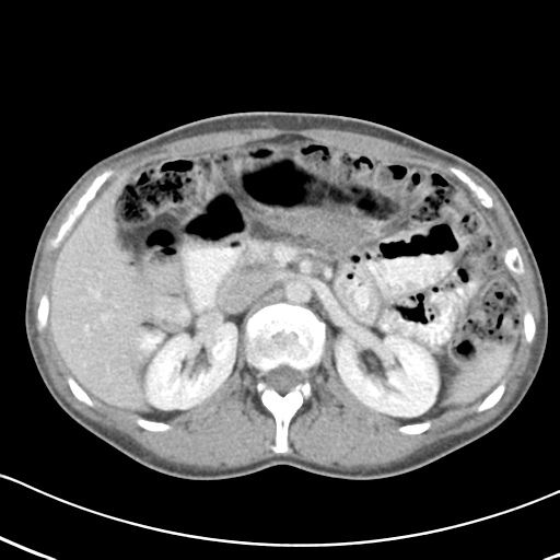 File:Abdominal desmoid tumor (Radiopaedia 41007-43740 Axial C+ portal venous phase 20).png
