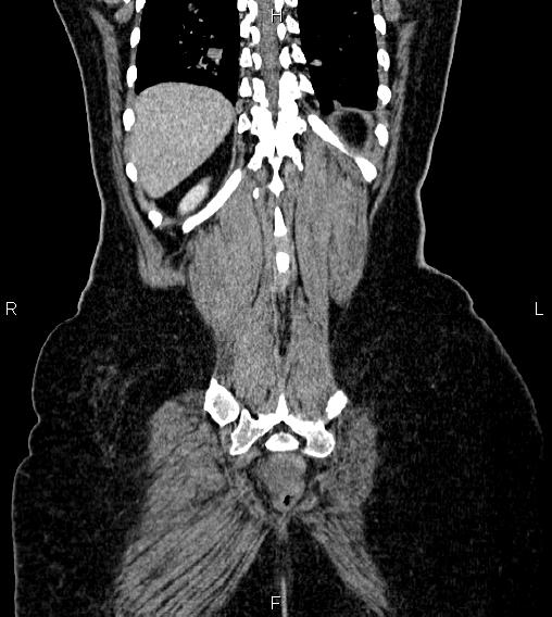 Abdominal lymphoma with sandwich sign (Radiopaedia 84378-99704 Coronal C+ portal venous phase 61).jpg