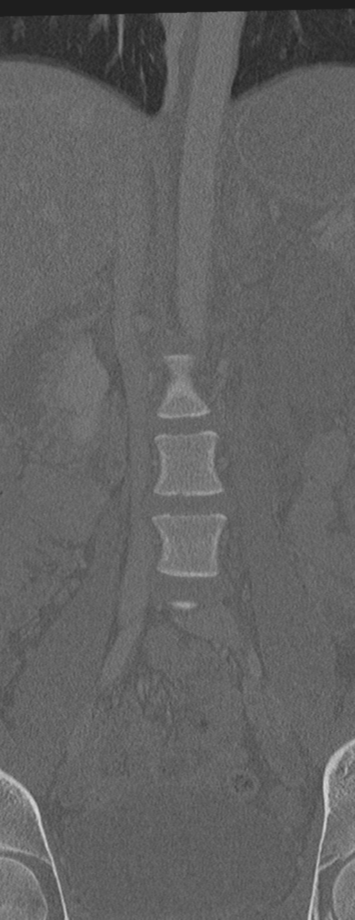 Abdominal multi-trauma - devascularised kidney and liver, spleen and pancreatic lacerations (Radiopaedia 34984-36486 Coronal bone window 16).png