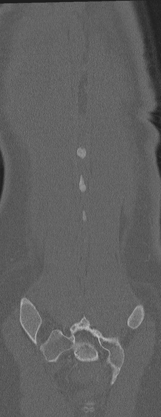 Abdominal multi-trauma - devascularised kidney and liver, spleen and pancreatic lacerations (Radiopaedia 34984-36486 Coronal bone window 65).png
