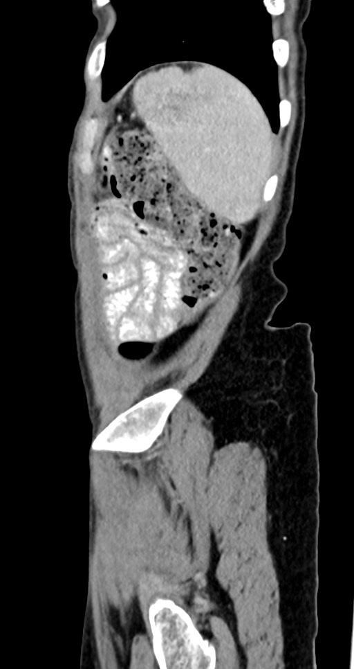 Abdominal wall and retroperitoneal tuberculosis (Radiopaedia 88137-104729 Sagittal C+ portal venous phase 25).jpg
